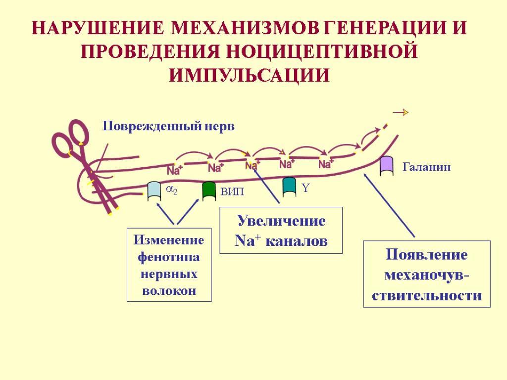 Поврежденный нерв Увеличение Na+ каналов НАРУШЕНИЕ МЕХАНИЗМОВ ГЕНЕРАЦИИ И ПРОВЕДЕНИЯ НОЦИЦЕПТИВНОЙ ИМПУЛЬСАЦИИ Изменение фенотипа